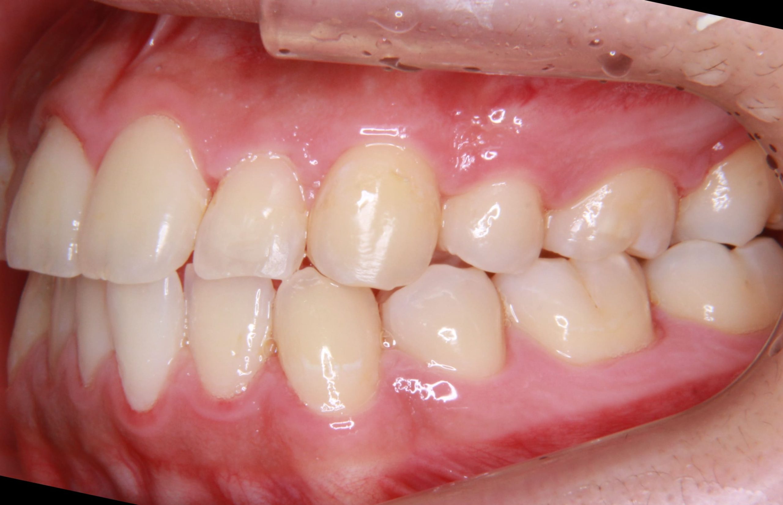 八重歯の矯正治療