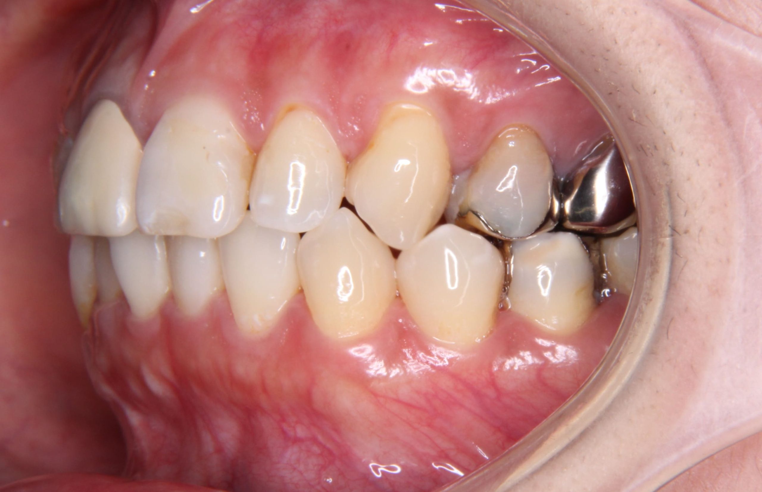 歯根破折により抜歯になった部位へのインプラント治療