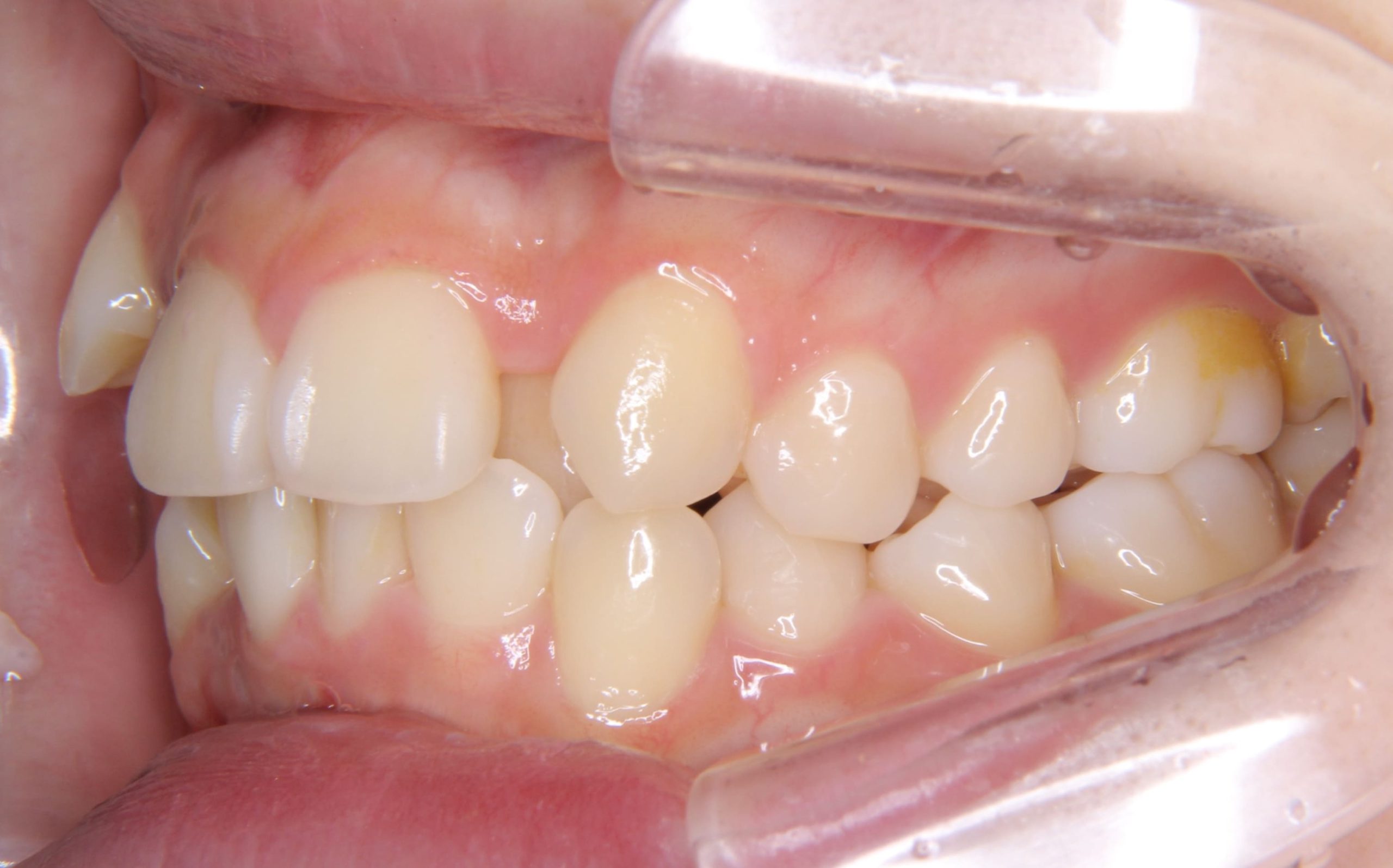 ガタガタ歯並び（叢生歯列）に対する矯正治療