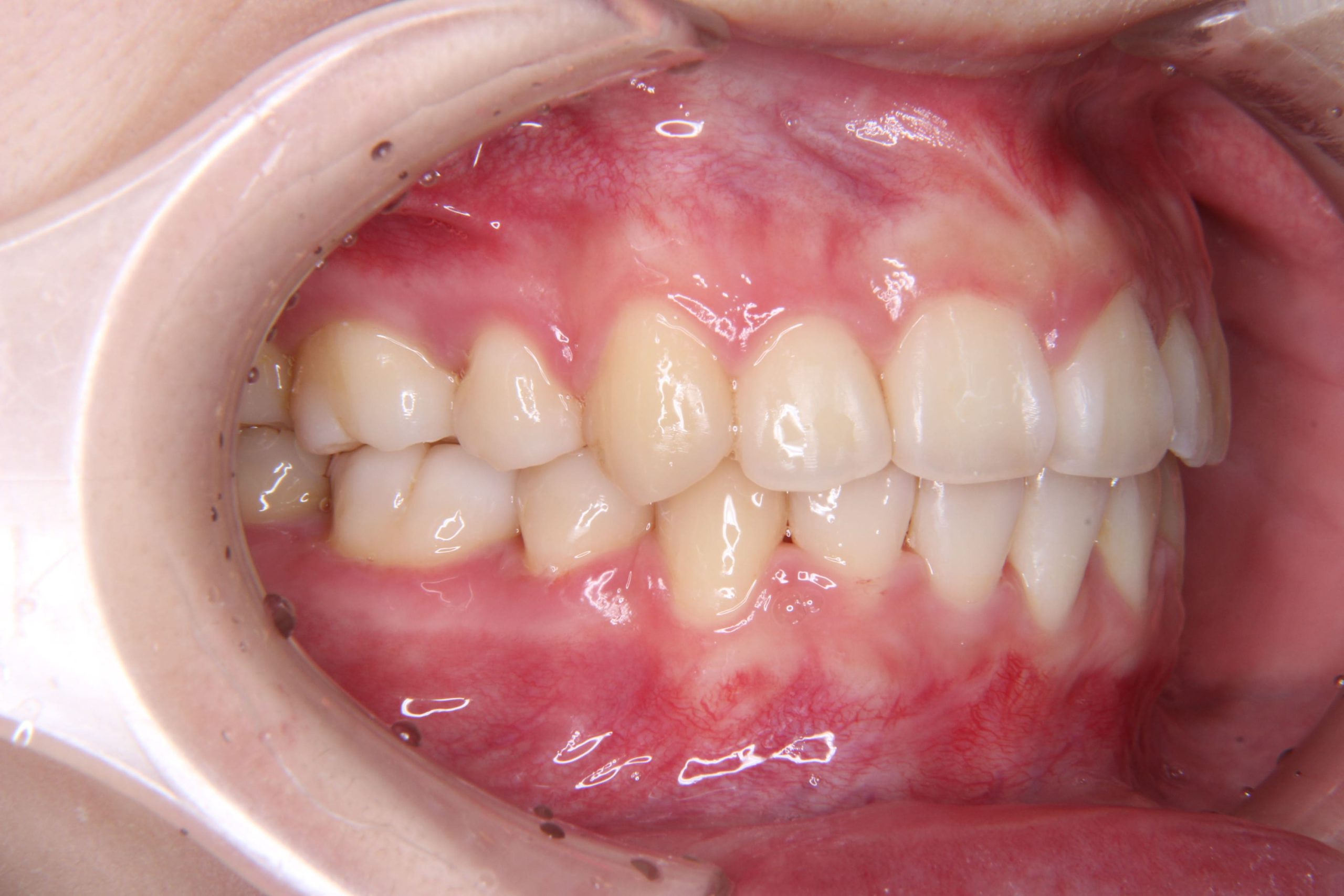 ガタガタ歯並び（叢生歯列）に対する矯正治療