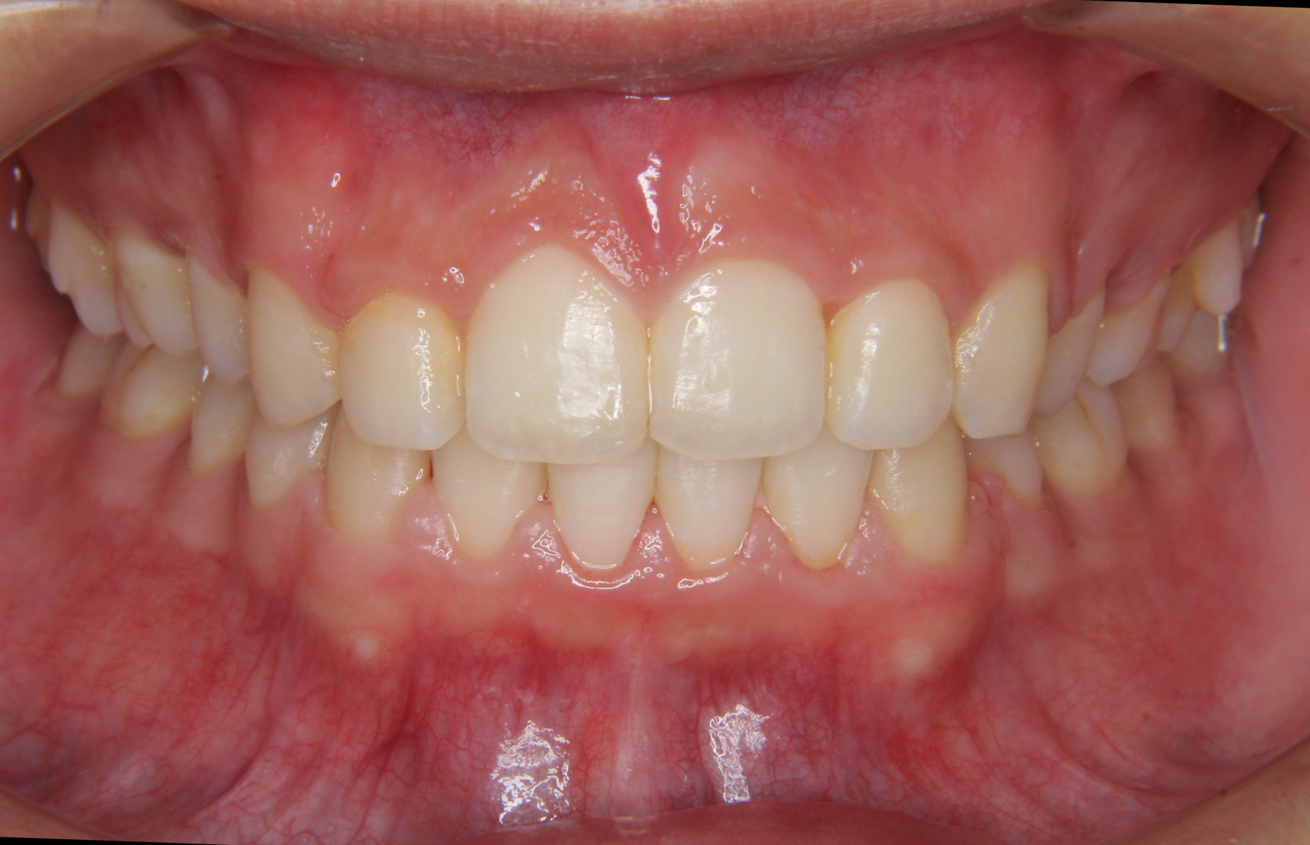 上の前歯が前に出ている（口ごぼ）方への矯正治療