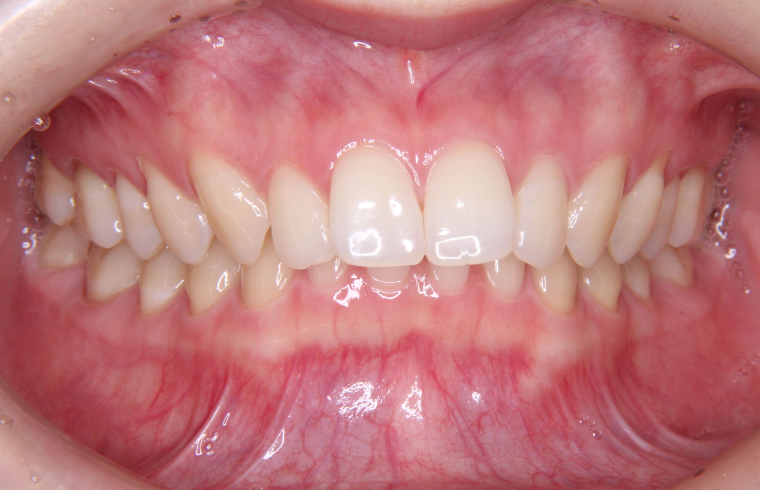 前歯が出ていて（口ボコ）、口を閉じにくい方に矯正治療した症例