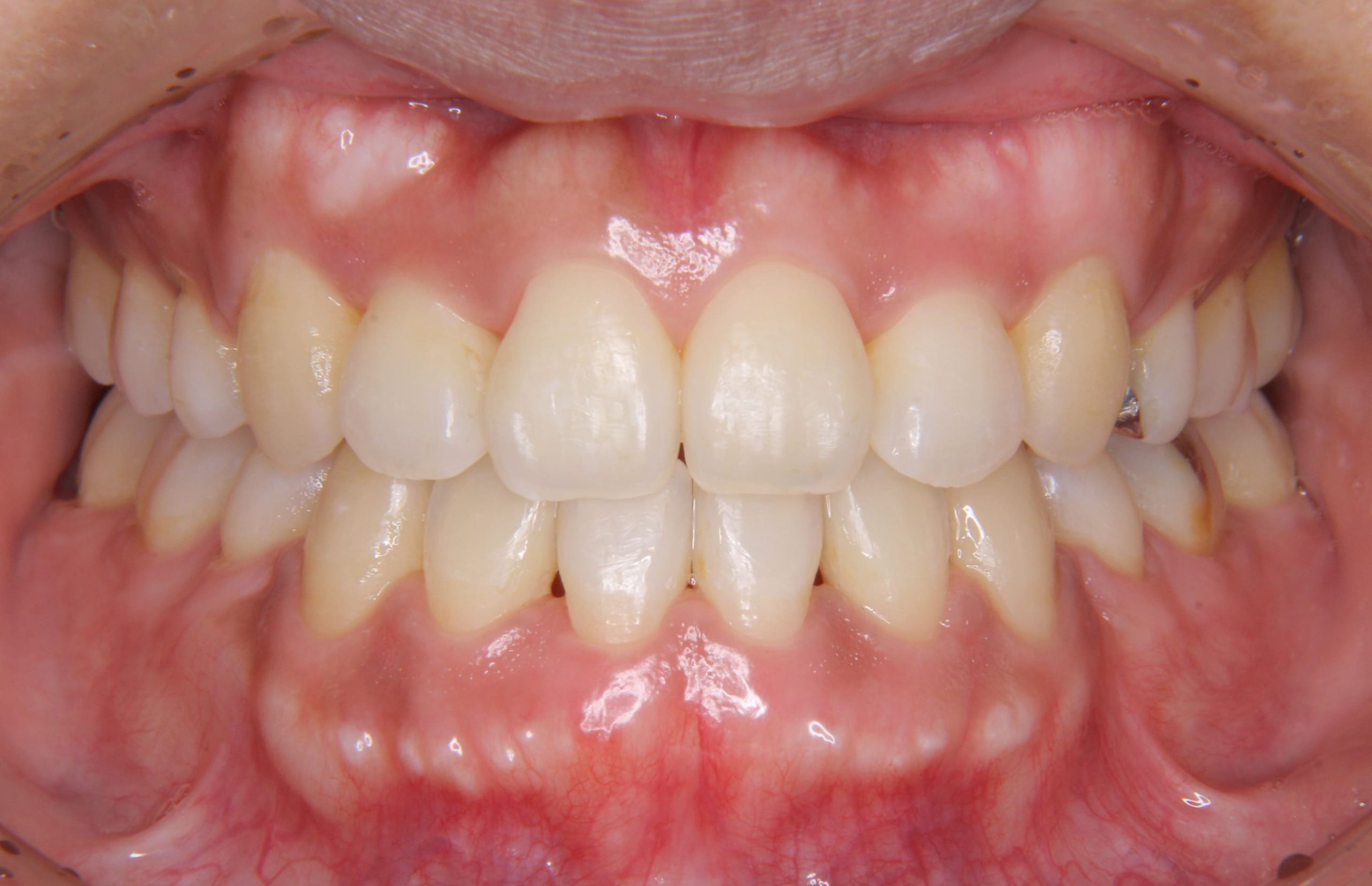 前歯の叢生（ガタガタ）と反対咬合を矯正治療した症例