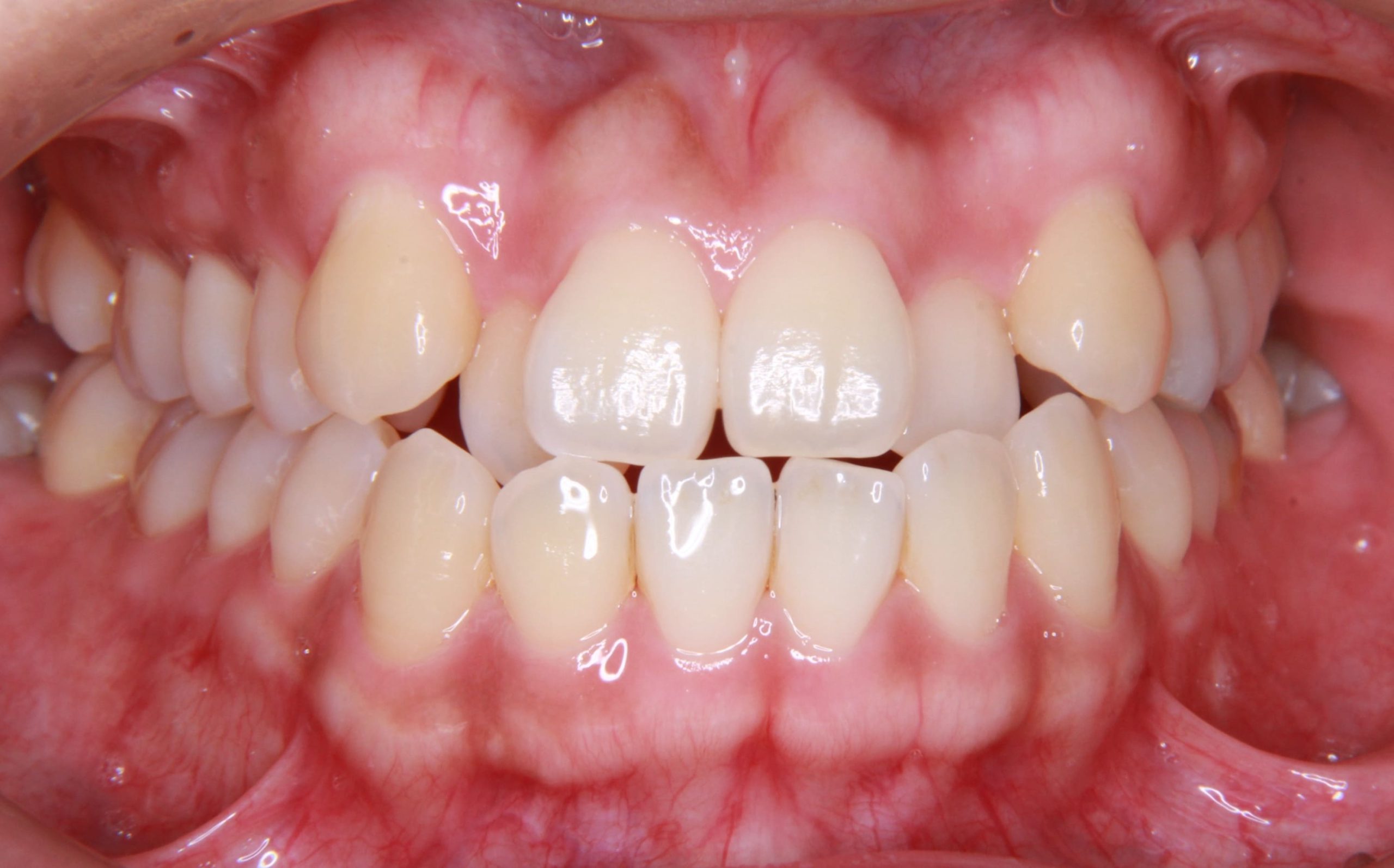 前歯の叢生（ガタガタ）と反対咬合を矯正治療した症例