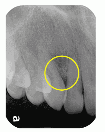 上の前歯の歯周病に対して歯周組織再生療法を行なった症例