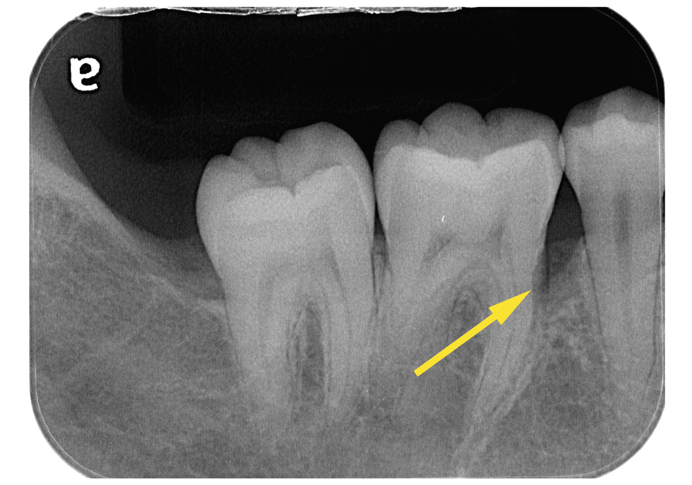 歯周病の進行を食い止める歯周組織再生療法