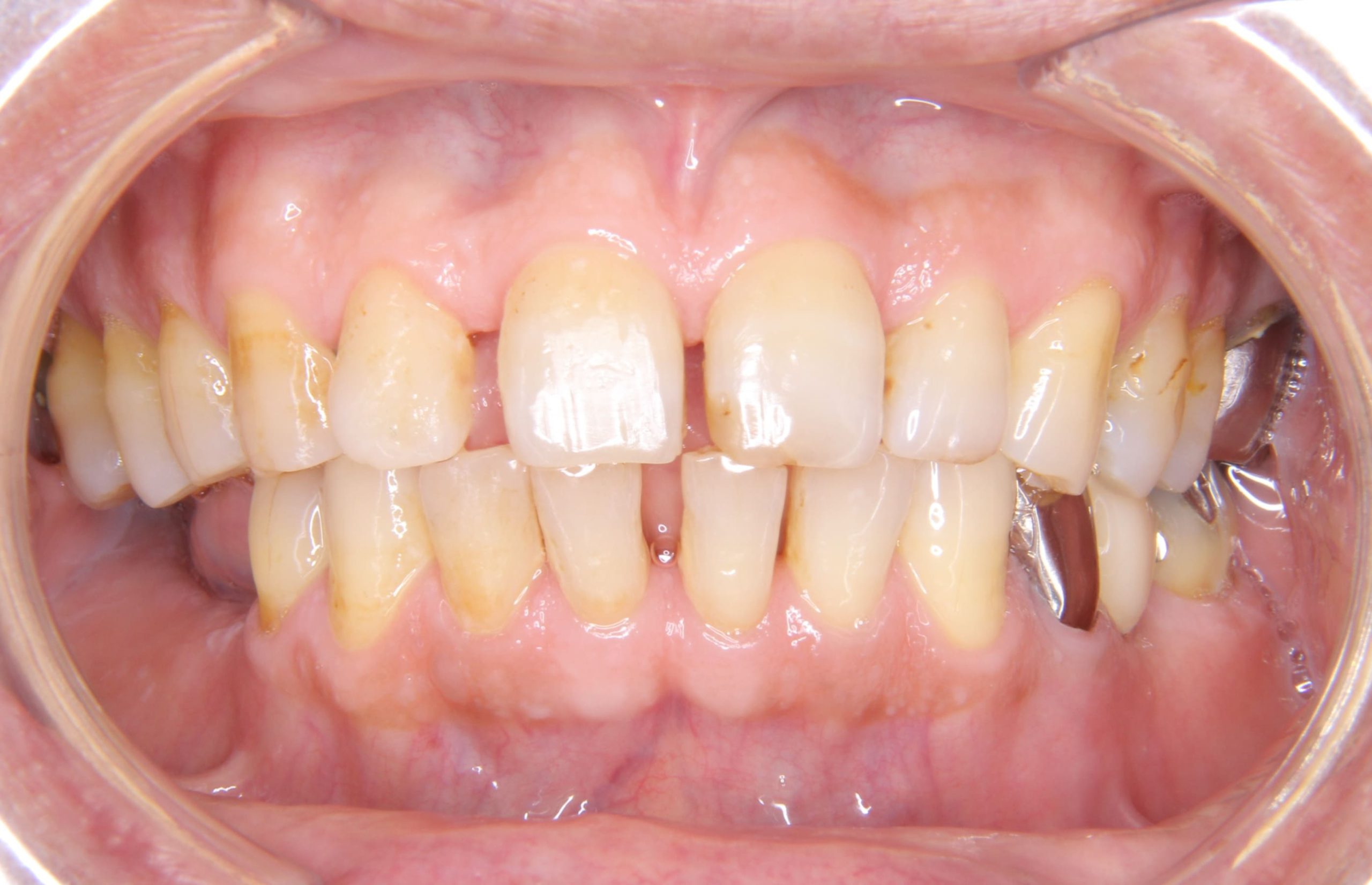 すきっ歯（空隙歯列）に対する治療法②