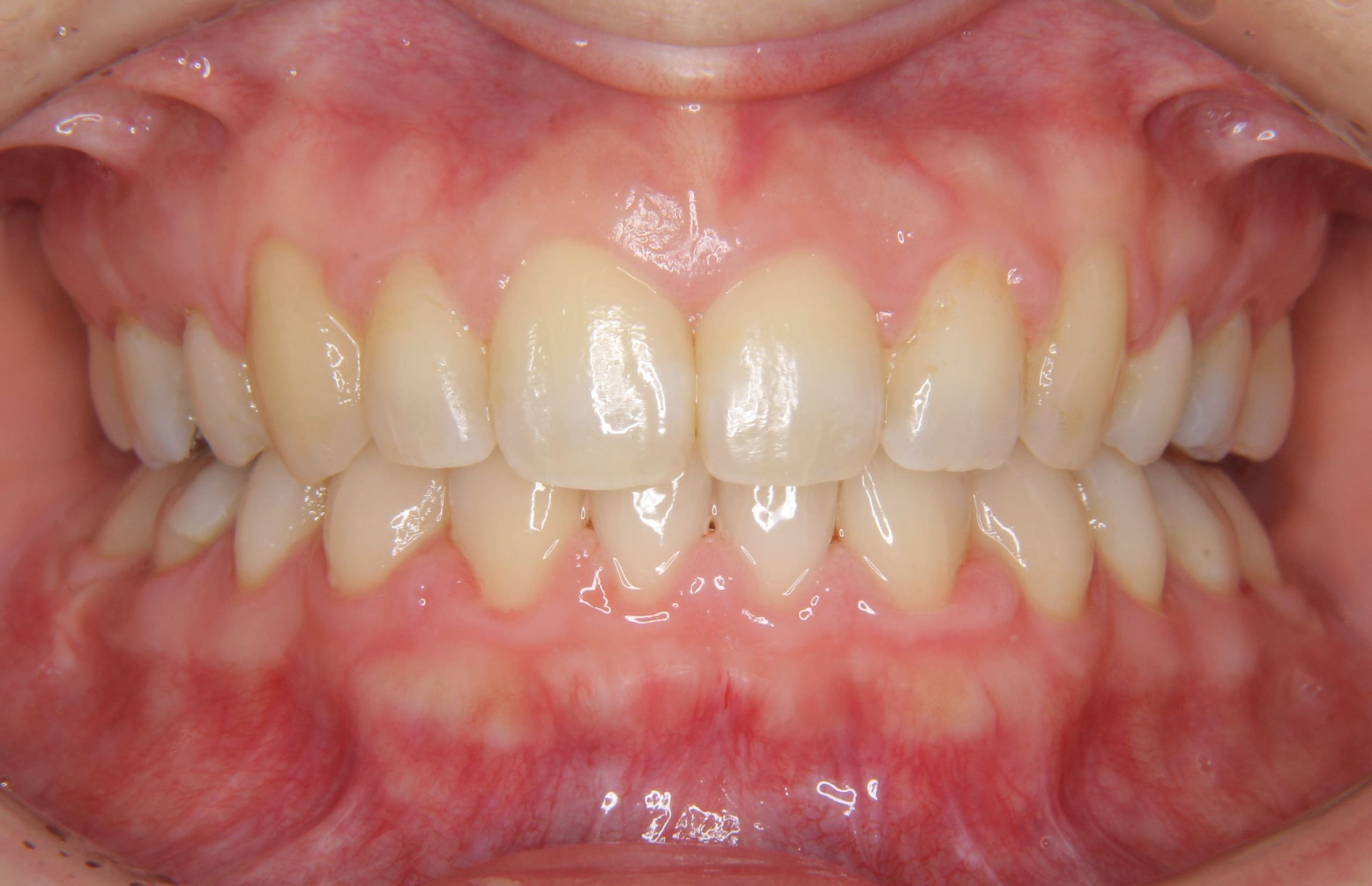 叢生歯列（ガタガタ、デコボコ歯並び）および下の歯が生まれつき２歯欠損している方への矯正治療