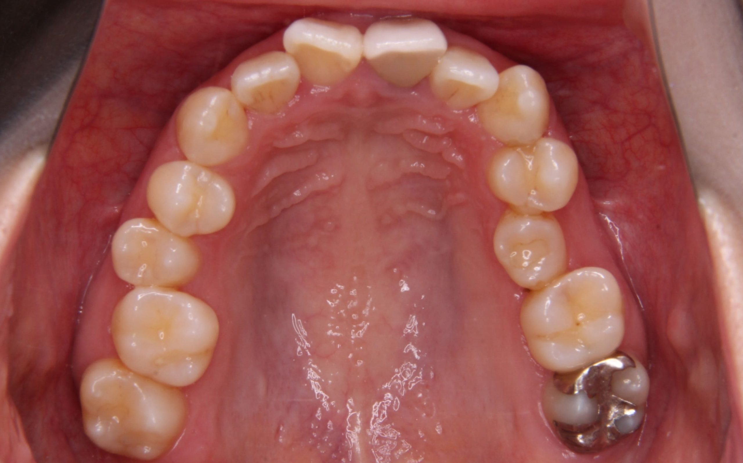 軽度の乱杭歯（叢生歯列）を矯正治療した症例。上の前歯のセラミック修復。