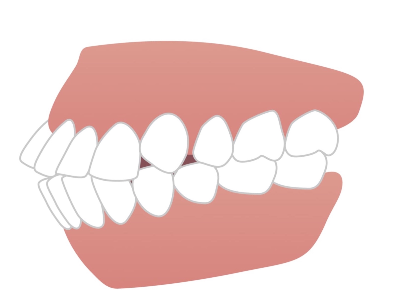 上下の前歯が出ていて、口が閉じにくい方への矯正治療